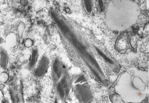 bone marrow - crystalloid inclusions Charcot-Leyden crystals formation